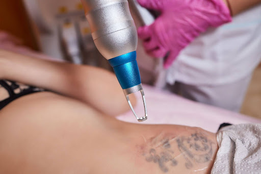Guide to Laser Tattoo Removal Costs